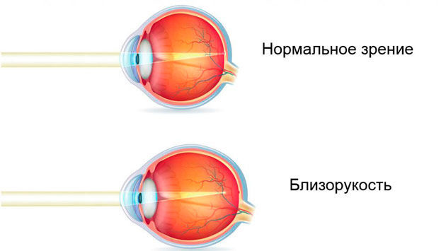 Вопрос эксперту: как победить детскую близорукость - Я Покупаю
