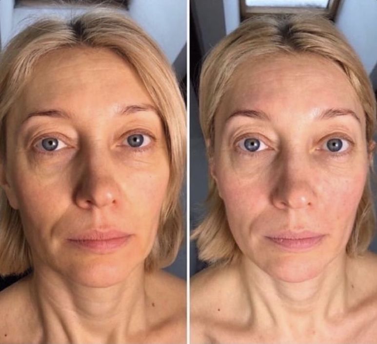 Уколы витаминов в лицо до и после фото