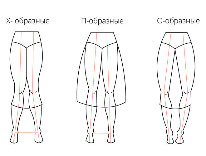 п образные ноги. п образные ноги. вальгусная деформация ног. варус коленных суставов у ребенка. х образное искривление ног.
