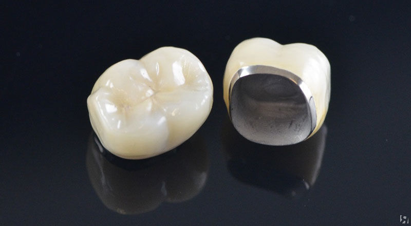 Что такое металлокерамика в стоматологии фото